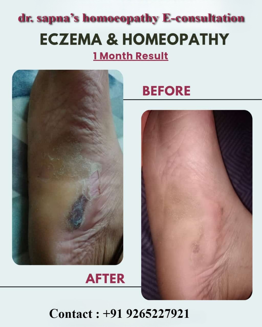 Healing of severe foot eczema after 1 month