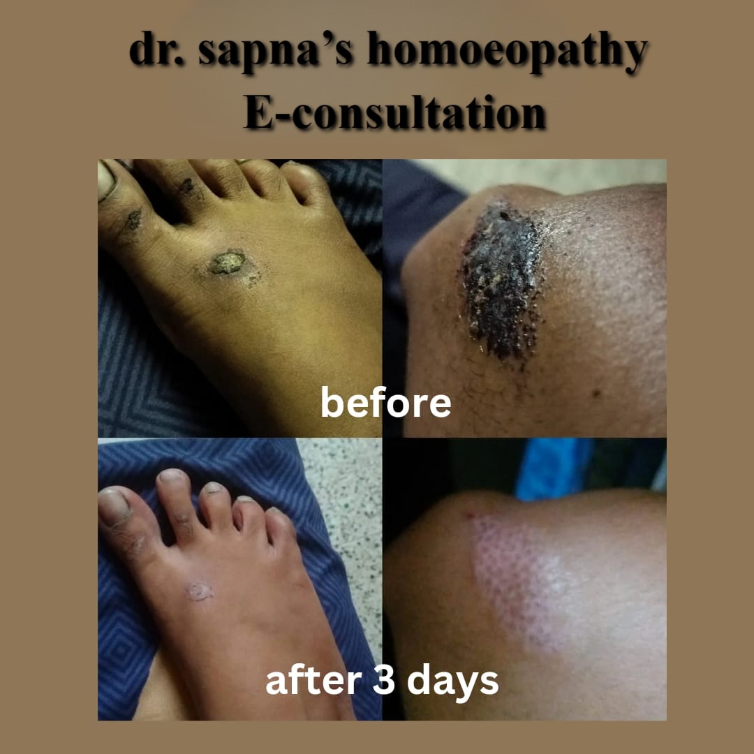 Healing of skin lesions after 3 days